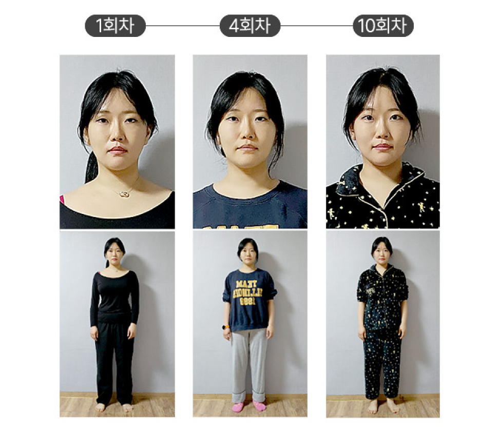 얼굴 축소 비포애프터