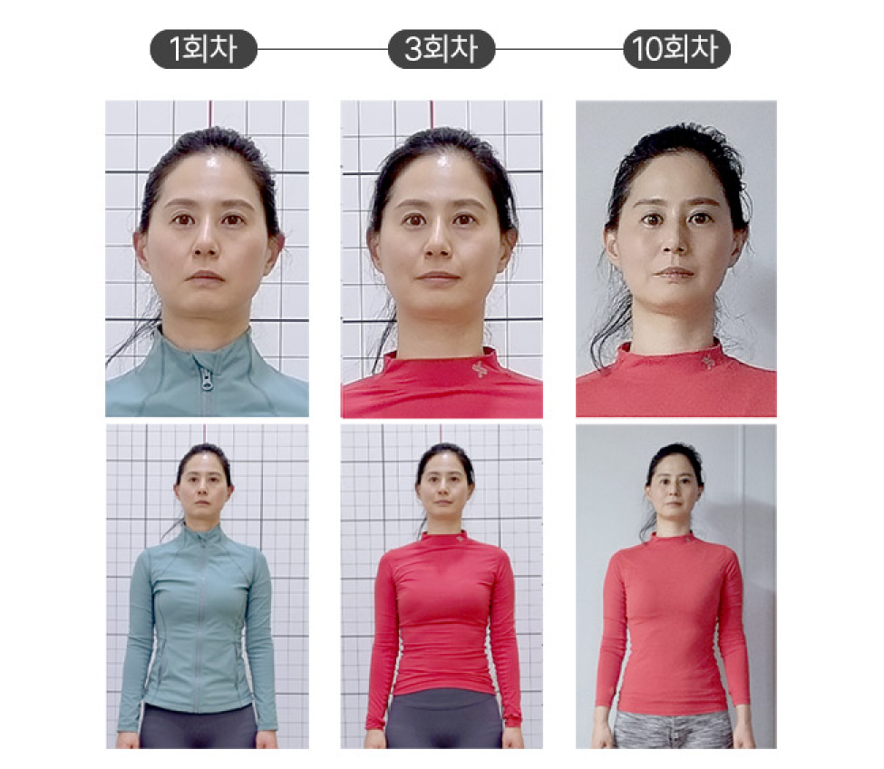 안면 비대칭 개선